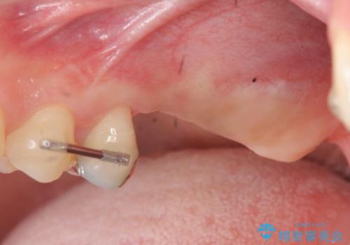 虫歯・破折の放置により重度に吸収した歯槽骨 骨造成後のインプラント治療の治療中