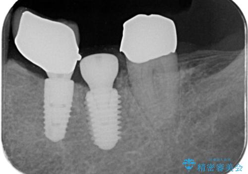 【1Dayインプラント治療! 低侵襲で短期間での治療】 咬むと歯が痛い! 歯根破折の治療中