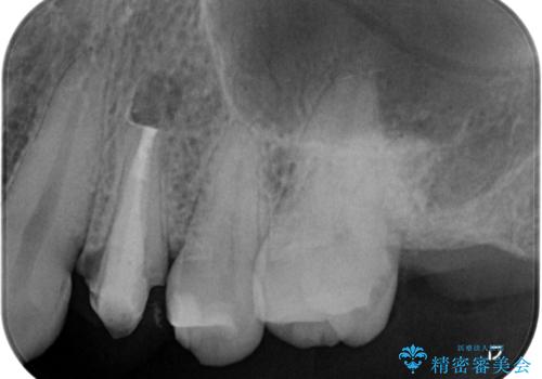 【外科的歯内療法】根管治療をしても違和感が残るの治療中
