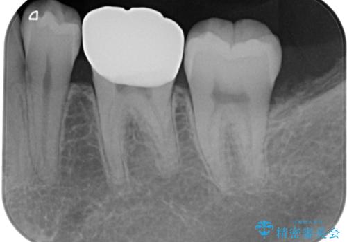 銀歯のところがしみる　オールセラミッククラウンの治療後