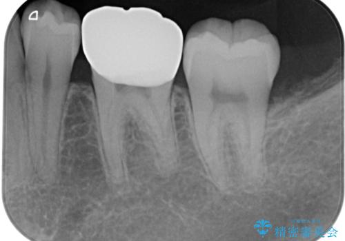 銀歯のところがしみる オールセラミッククラウンの治療後