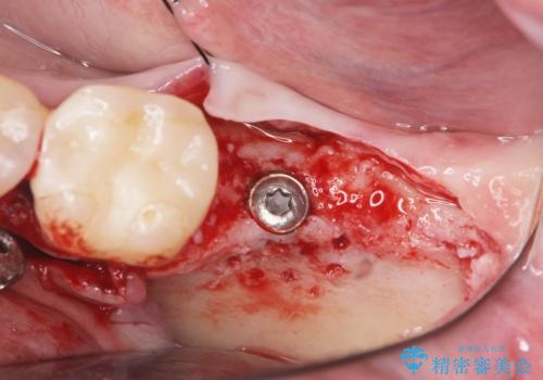 歯からの異臭　虫歯の再発からのインプラント治療の治療中