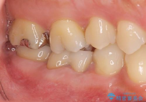 歯周病治療＆セラミック治療の症例 治療後