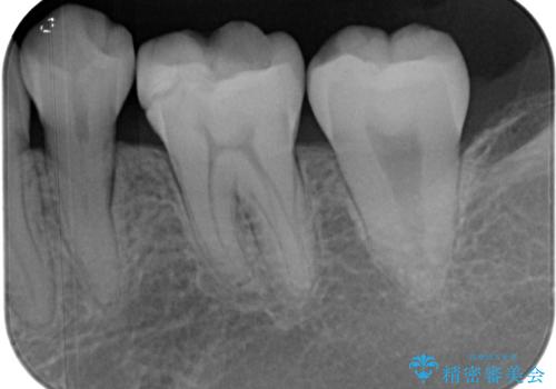 保険の白い詰め物が割れた ハイブリッドインレーの治療前