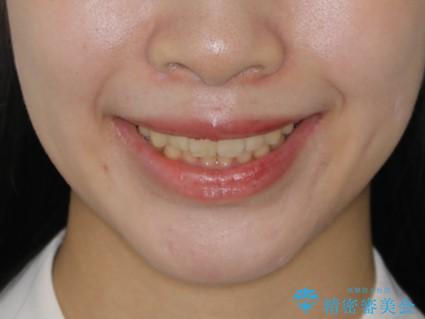 前歯のがたつきとディープバイト:インビザライン治療の治療後(顔貌)