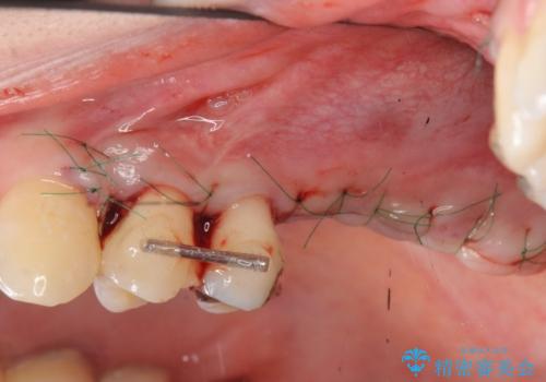 虫歯・破折の放置により重度に吸収した歯槽骨 骨造成後のインプラント治療の治療中