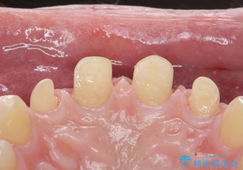 前歯の隙間を埋めたい 矯正かクラウンかの治療中