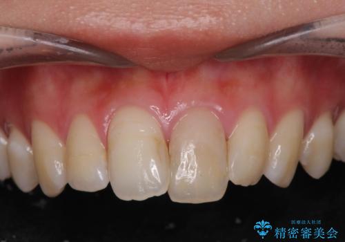 前歯の変色を改善するセラミッククラウン治療の症例 治療前