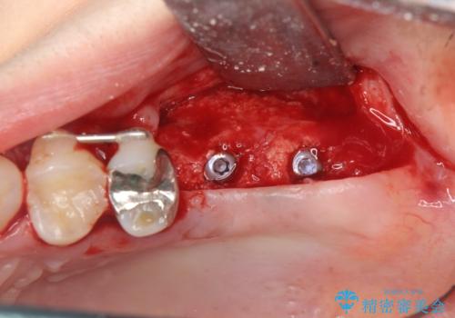 虫歯・破折の放置により重度に吸収した歯槽骨　骨造成後のインプラント治療の治療中