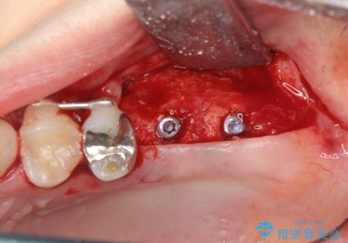 虫歯・破折の放置により重度に吸収した歯槽骨 骨造成後のインプラント治療の治療中