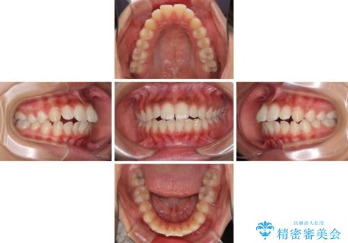くちばしのように突出した前歯　口元を下げる抜歯矯正の治療前