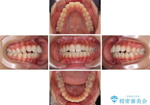 くちばしのように突出した前歯 口元を下げる抜歯矯正の治療前