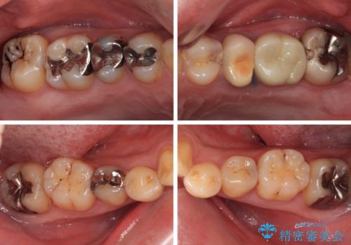 銀歯をなくしたい　全顎的なむし歯治療の治療前