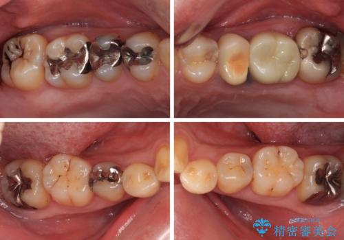 銀歯をなくしたい 全顎的なむし歯治療の治療前