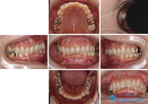 デコボコの歯とむし歯 インビザライン矯正治療とむし歯治療の治療前