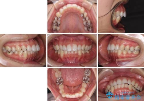 顎先に梅干し皺ができる 閉じにくい唇を抜歯矯正で閉じやすくの治療前