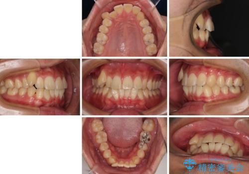 八重歯を無理なくなおしたい　ワイヤー装置による非抜歯矯正治療の治療前