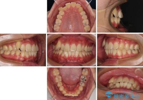 八重歯を無理なくなおしたい ワイヤー装置による非抜歯矯正治療の治療前