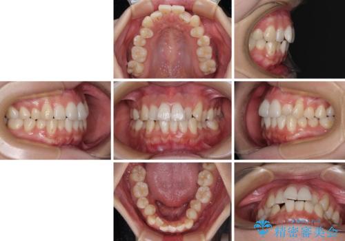急速拡大装置 狭い歯列を拡大してワイヤー装置で短期間治療の治療前
