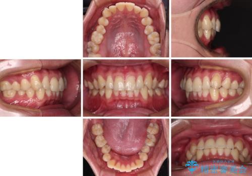 上下のデコボコを治したい インビザラインによる矯正治療の治療前