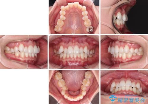 【モニター】インビザラインで気になるデコボコと八重歯をきれいに整えるの治療前