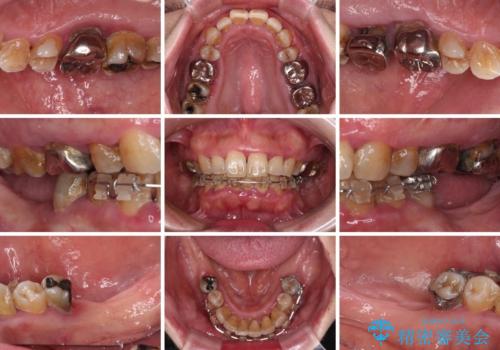 治療中で放置 インプラントでしっかりと咬めるようにの治療前