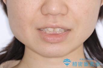 前歯のねじれと深い噛み合わせの改善:インビザライン治療の治療前(顔貌)