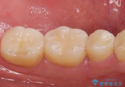 詰め物の治療。の治療前