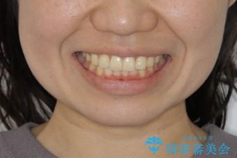 前歯のねじれと深い噛み合わせの改善:インビザライン治療の治療後(顔貌)