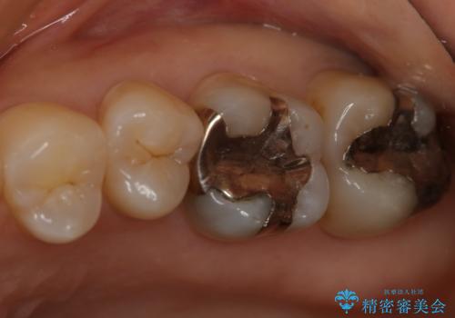 奥歯を白くしたいの治療前