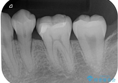 保険の白い詰め物が割れた　ハイブリッドインレーの治療後