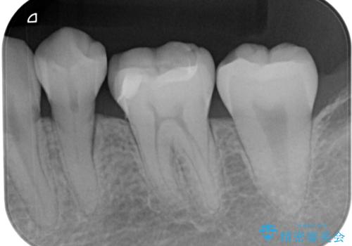 保険の白い詰め物が割れた ハイブリッドインレーの治療後