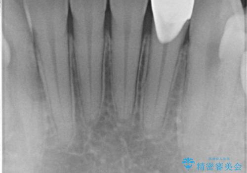 下の前歯が欠けている　セラミックで審美的に　エアフローで着色除去もの治療後