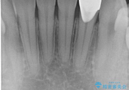 下の前歯が欠けている セラミックで審美的に エアフローで着色除去もの治療後
