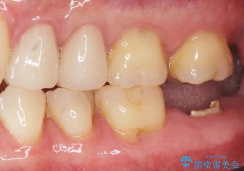 歯からの異臭　虫歯の再発からのインプラント治療の治療前