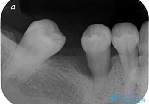 【再生治療】歯がぐらぐらして怖いの症例 治療前