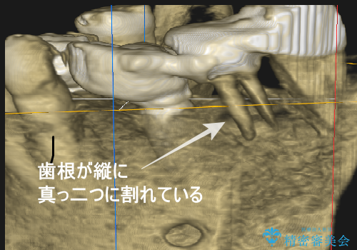 【1Dayインプラント治療!　低侵襲で短期間での治療】　咬むと歯が痛い!　歯根破折の治療中