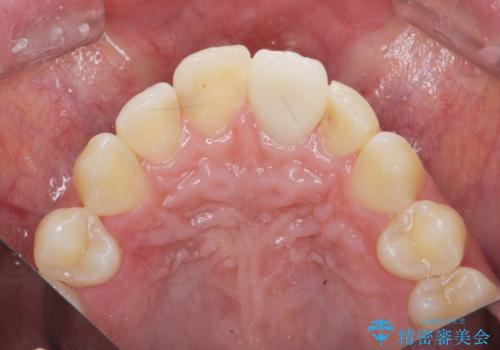 前歯の変色を改善するセラミッククラウン治療の治療後
