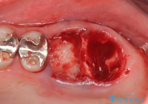 虫歯・破折の放置により重度に吸収した歯槽骨 骨造成後のインプラント治療の治療前