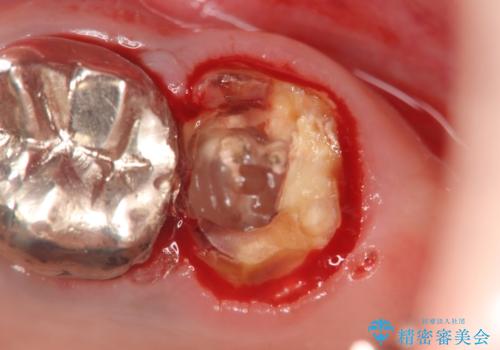 虫歯・破折の放置により重度に吸収した歯槽骨 骨造成後のインプラント治療の治療前