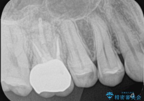 【奥歯のセラミッククラウン】他院で根管治療も必要だといわれた。の治療後