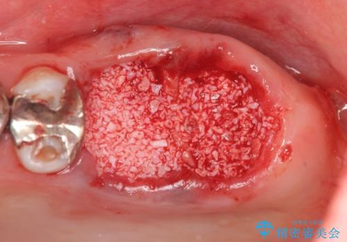 虫歯・破折の放置により重度に吸収した歯槽骨　骨造成後のインプラント治療の治療前