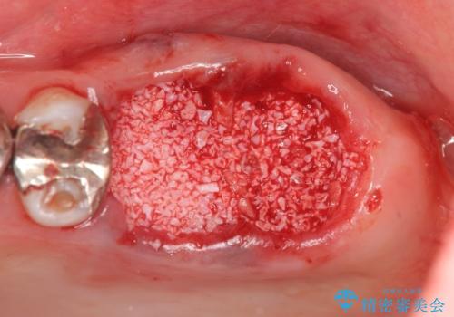 虫歯・破折の放置により重度に吸収した歯槽骨 骨造成後のインプラント治療の治療前