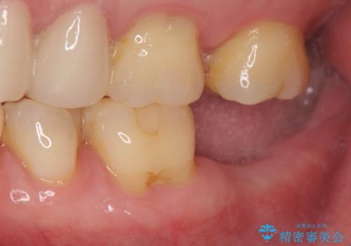 歯からの異臭　虫歯の再発からのインプラント治療の治療中