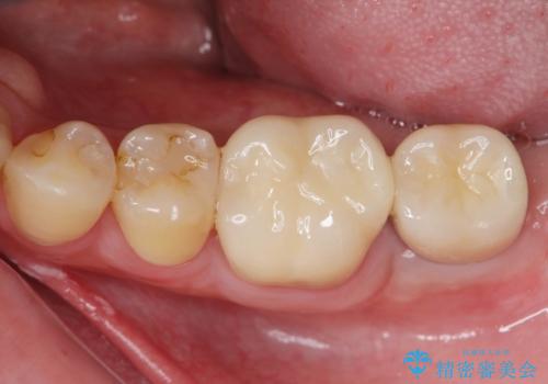 [ 歯の破折 ] 取れない違和感 歯の破折をインプラント治療で改善の治療後