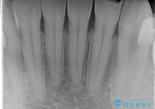 下の前歯が欠けている セラミックで審美的に エアフローで着色除去もの治療前