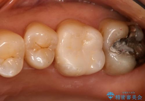 奥歯を白くしたいの症例 治療後