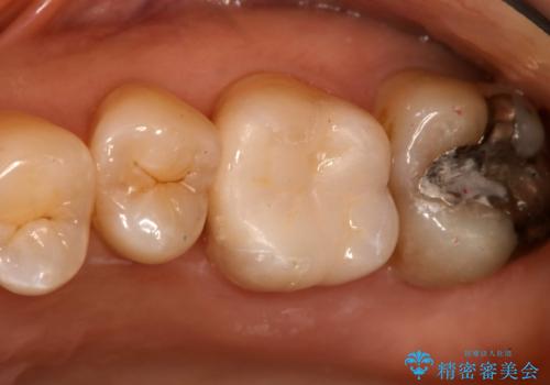奥歯を白くしたいの治療後