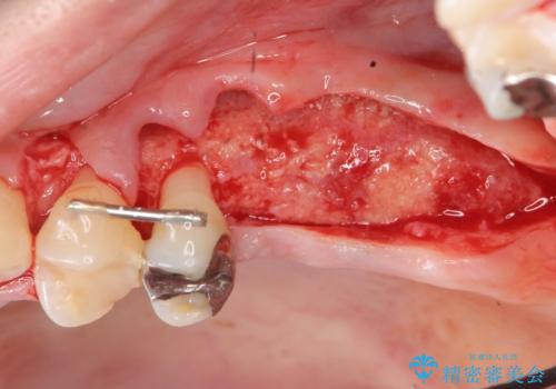 虫歯・破折の放置により重度に吸収した歯槽骨　骨造成後のインプラント治療の治療中