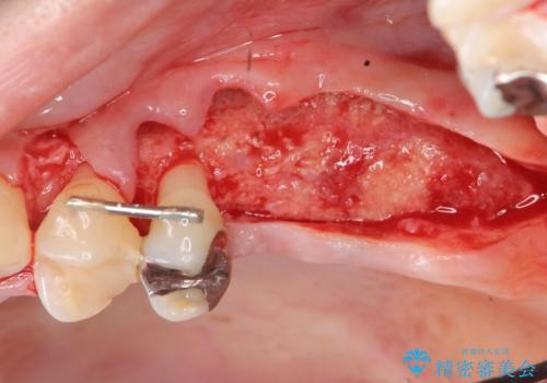 虫歯・破折の放置により重度に吸収した歯槽骨 骨造成後のインプラント治療の治療中